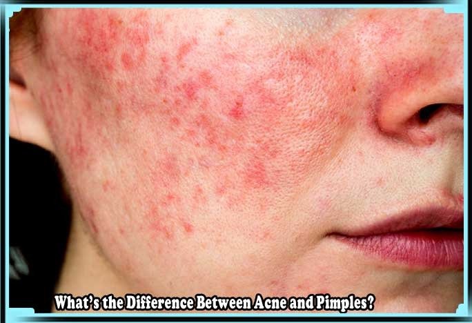 Difference Between Acne and Pimples