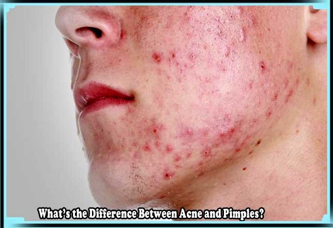 Difference Between Acne and Pimples